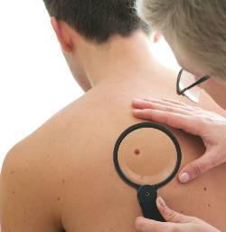Lidhja e fortë që ekziston mes rasteve të melanomës dhe plotësimit me vitaminë D